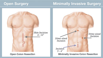 minimally invasive surgery procedures treating mip recovery scarring cancer procedure less hospital incisions surgical technique usually means pain